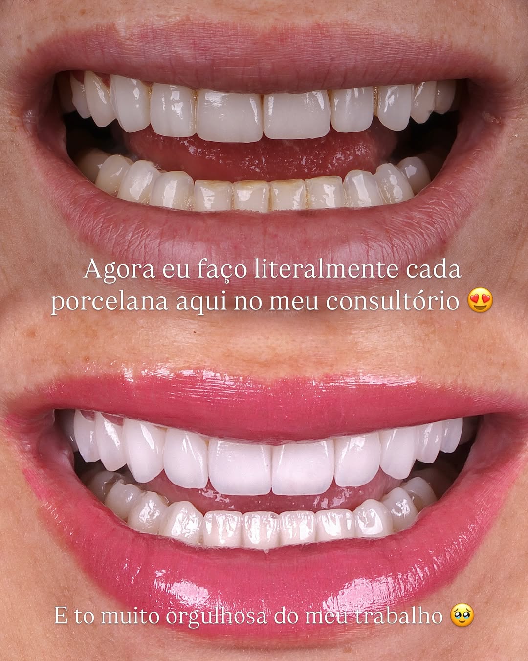 Antes e depois — Lentes de porcelana