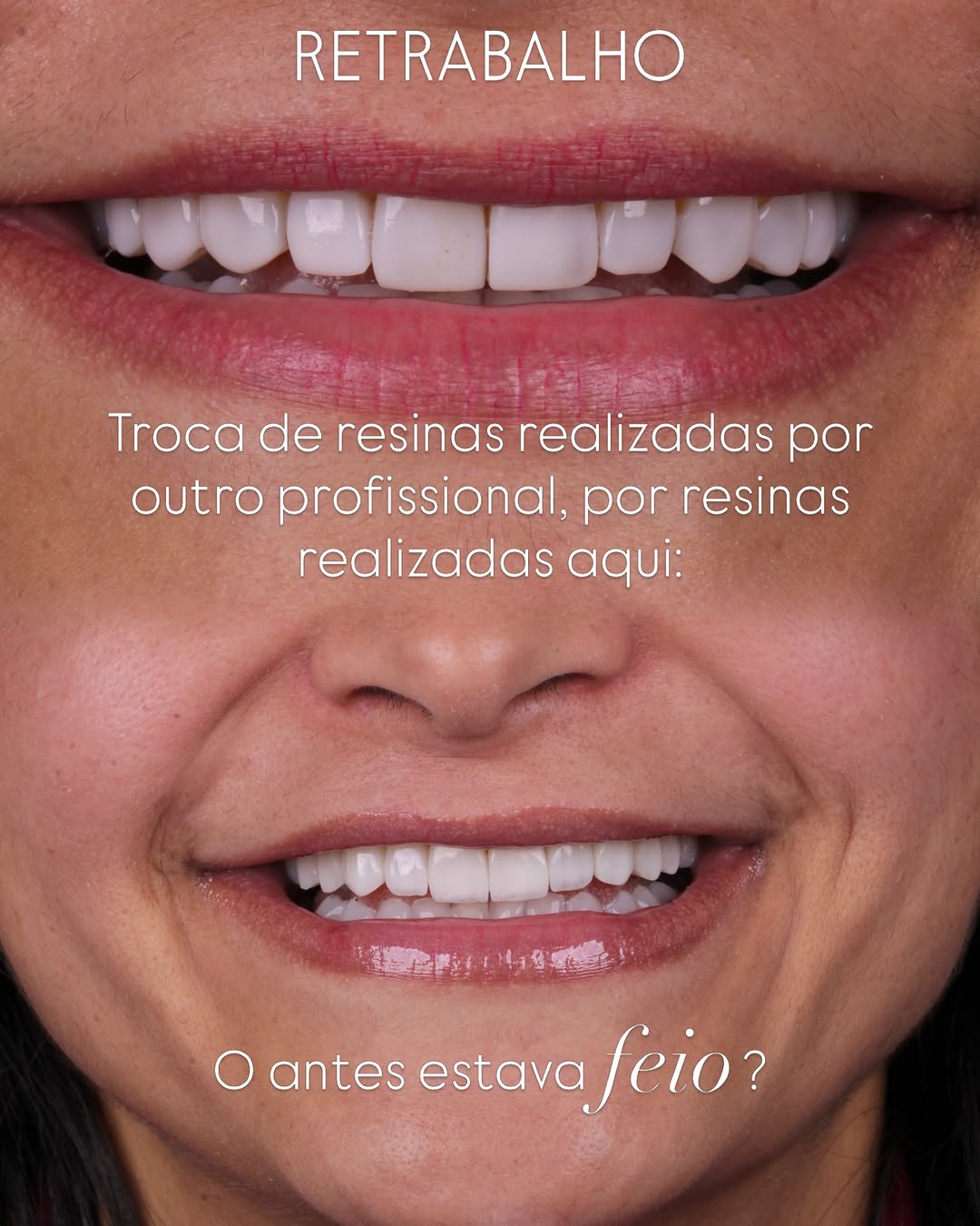 Antes e depois — Facetas em resina